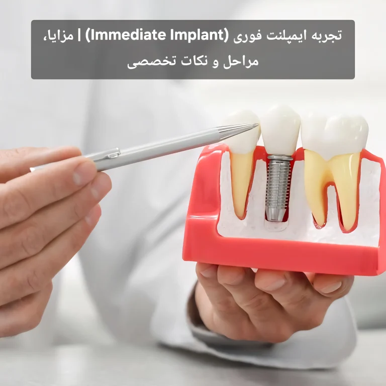 تجربه ایمپلنت فوری (Immediate Implant) | مزایا، مراحل و نکات تخصصی