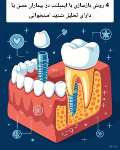 4 روش‌ بازسازی با ایمپلنت در بیماران مسن یا دارای تحلیل شدید استخوانی