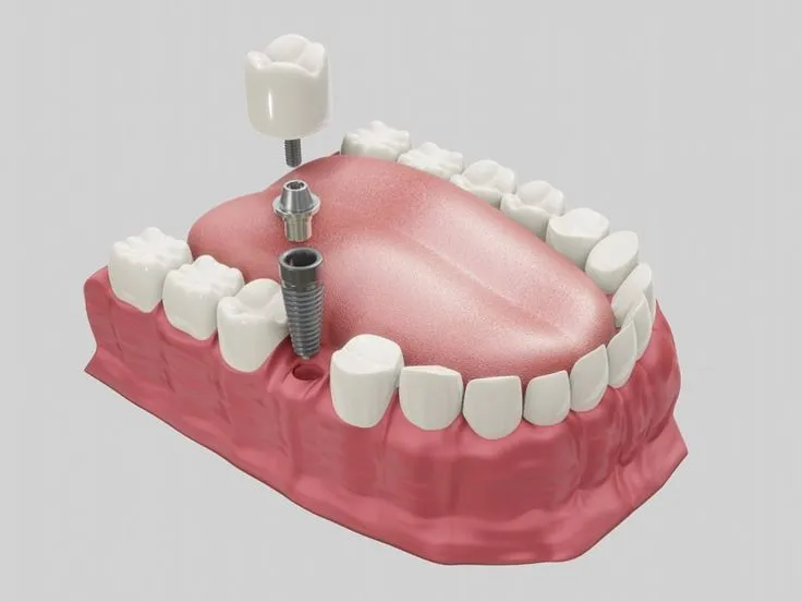 مراحل ایمپلنت دندان | راهنمای جامع 2025