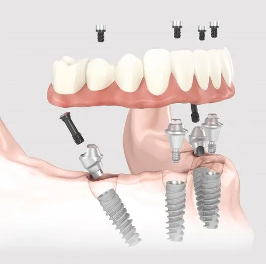 مراقبتهای بعد از نصب پروتز ثابت | راهنمای جامع 2025