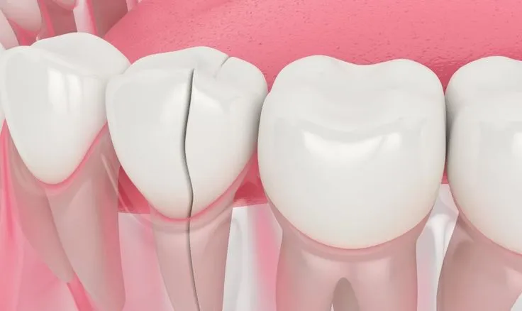 مقایسه روشهای بازسازی تاج دندانهای به شدت تخریب شده | راهنمای جامع 2025