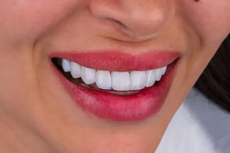 تفاوت لمینیت دندان (سرامیکی) و کامپوزیت ونیر | راهنمای جامع 2025