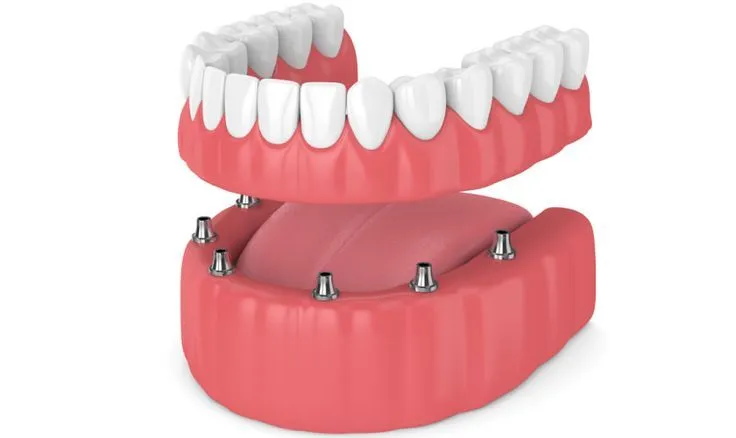 درمان اوردنچر (Overdenture) : ترکیب نوین ایمپلنت و پروتز متحرک | راهنمای جامع 2025
