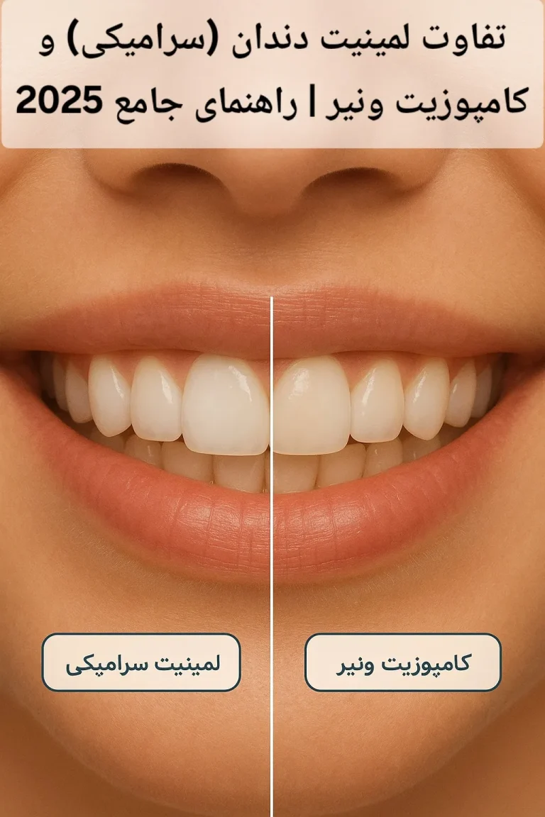 تفاوت لمینیت دندان (سرامیکی) و کامپوزیت ونیر | راهنمای جامع 2025
