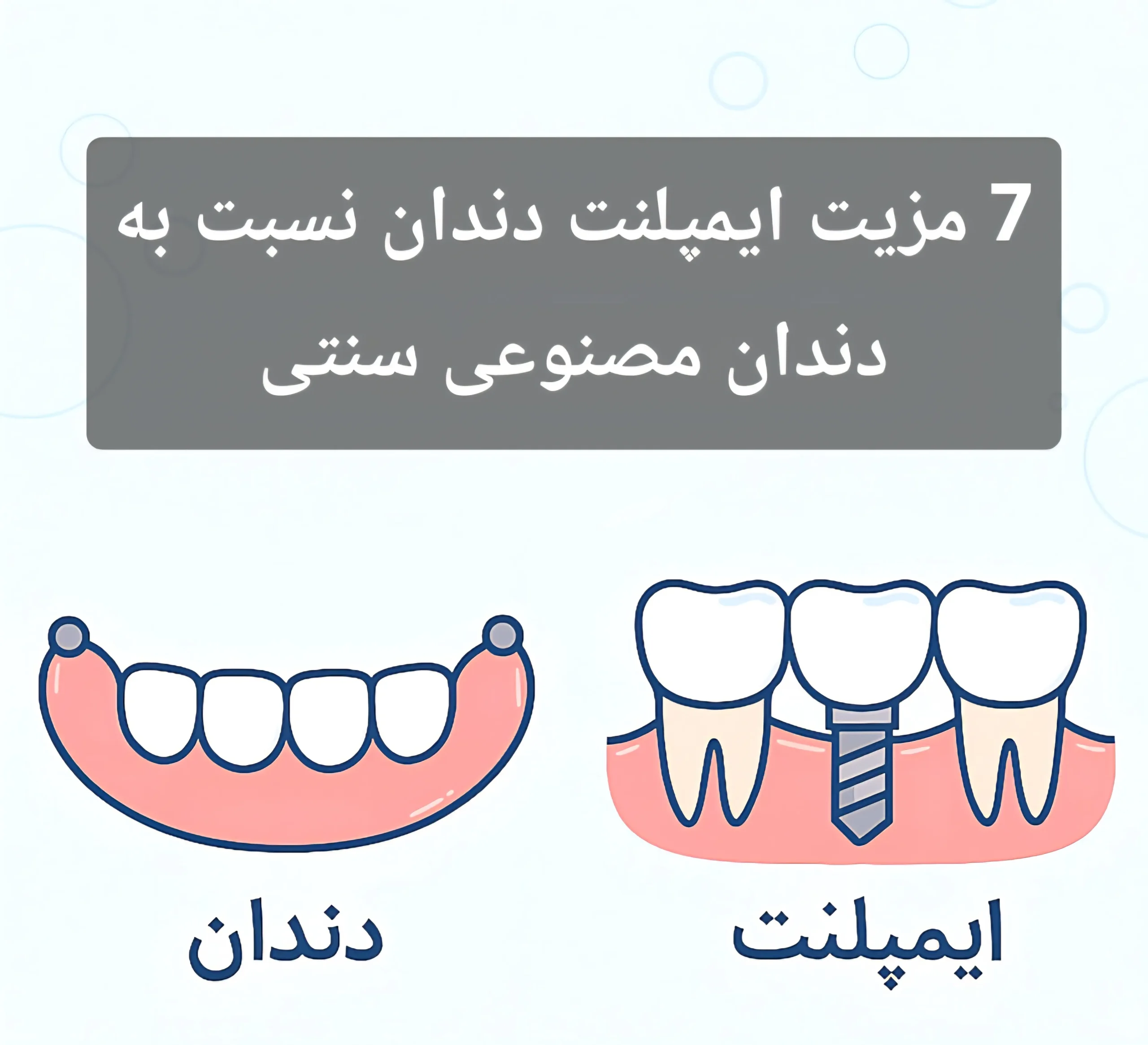 7 مزیت ایمپلنت دندان نسبت به دندان مصنوعی سنتی
