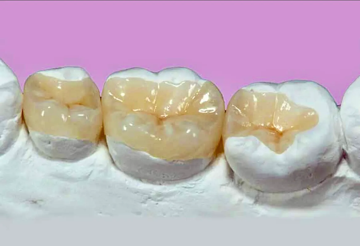 ترمیم های سرامیکی (Inlay، Onlay، Endocrown) | راهنمای جامع علم و زیبایی در دندانپزشکی 2025