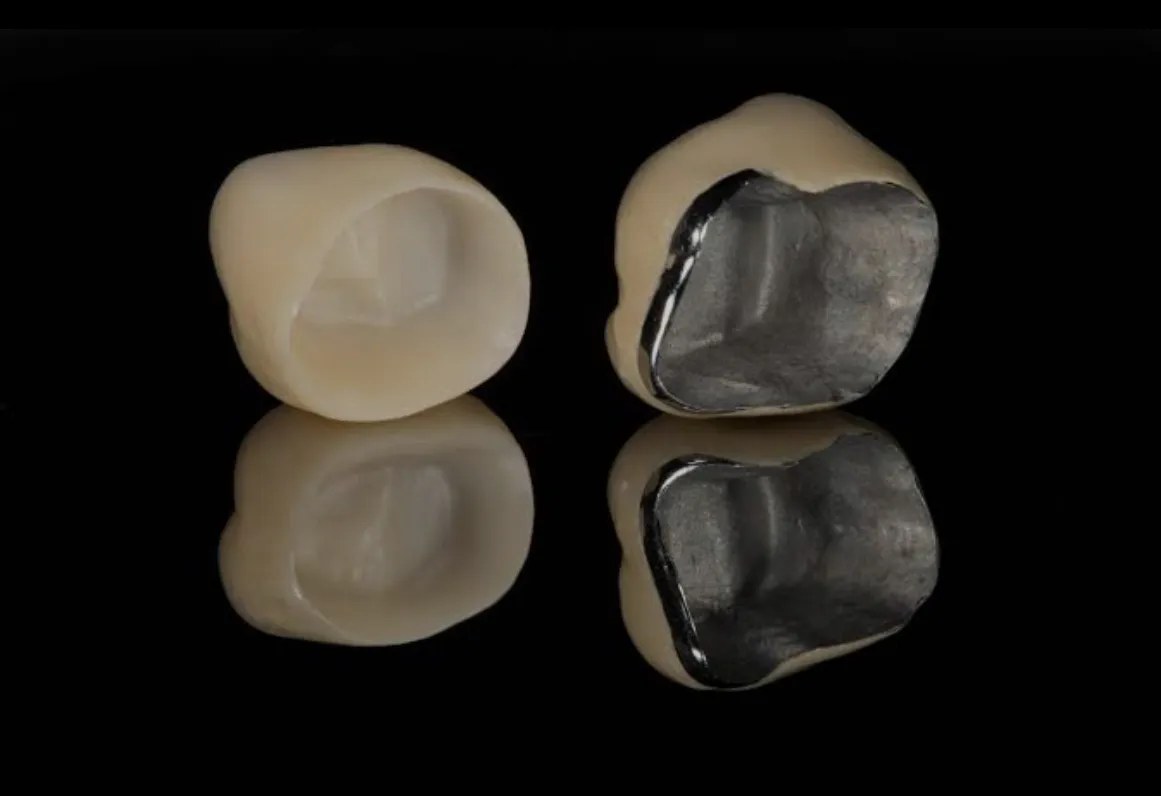 انواع روکش دندان از لحاظ متریال | راهنمای جامع 2025