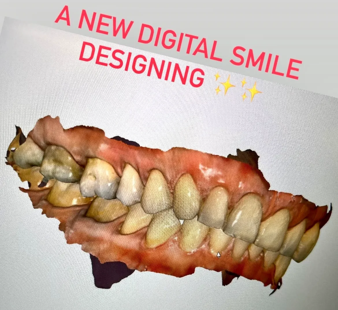 مقایسه قالبگیری دیجیتال و قالبگیری معمول | راهنمای جامع 2025