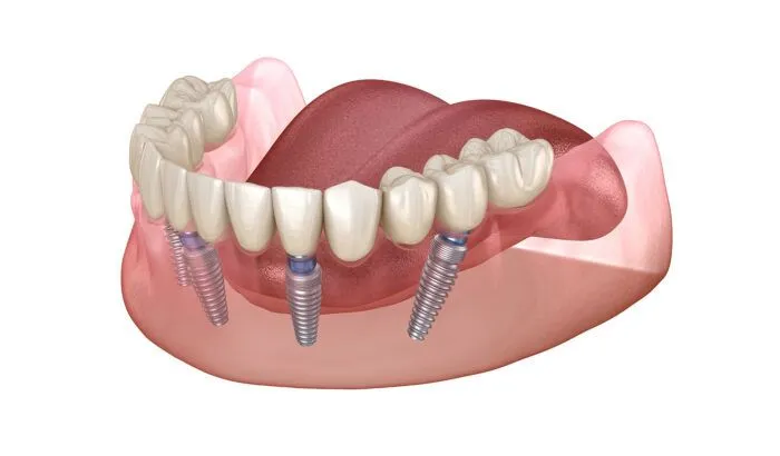 مراقبتهای بعد از نصب پروتز ثابت | راهنمای جامع 2025