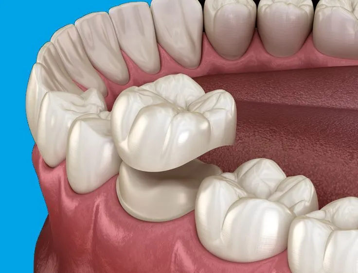 انواع روکش دندان از لحاظ متریال | راهنمای جامع 2025