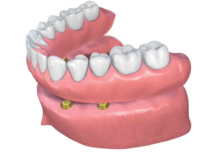 درمان اوردنچر (Overdenture) : ترکیب نوین ایمپلنت و پروتز متحرک | راهنمای جامع 2025