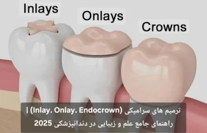ترمیم های سرامیکی (Inlay، Onlay، Endocrown) | راهنمای جامع علم و زیبایی در دندانپزشکی 2025