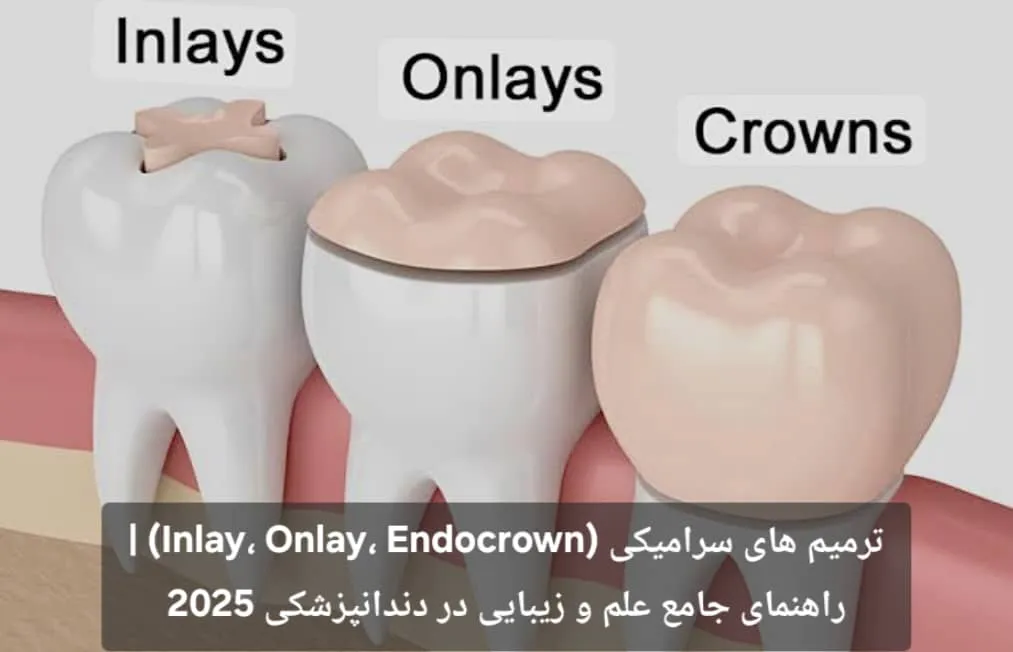 ترمیم های سرامیکی (Inlay، Onlay، Endocrown) | راهنمای جامع علم و زیبایی در دندانپزشکی 2025