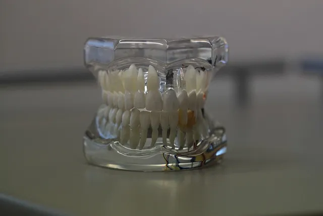 7 مزیت ایمپلنت دندان نسبت به دندان مصنوعی سنتی