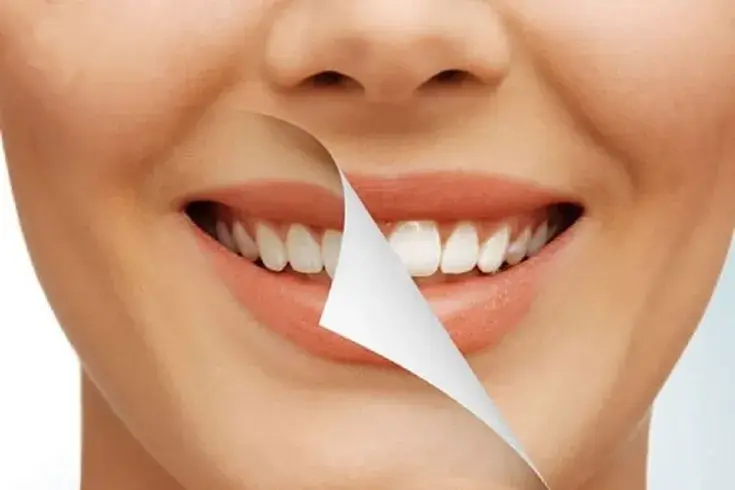 انواع روکش دندان از لحاظ متریال | راهنمای جامع 2025