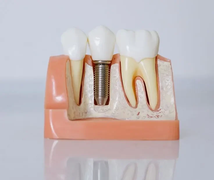 7 فاکتور مؤثر در قیمت ایمپلنت در ایران