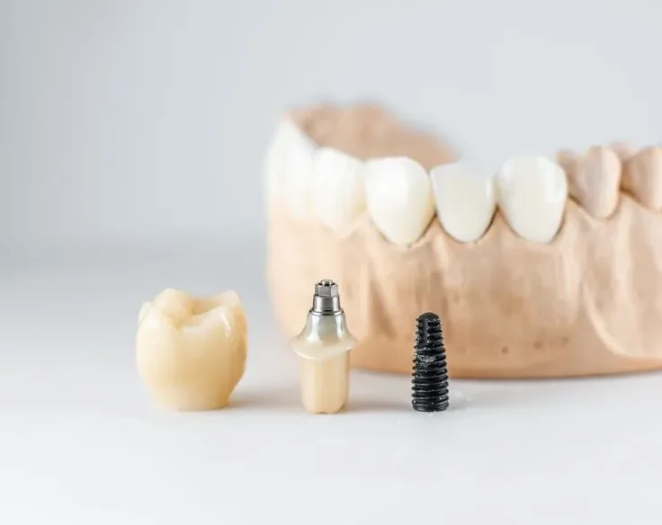 مشکلات رایج بعد از ایمپلنت دندان + پیشگیری 2025