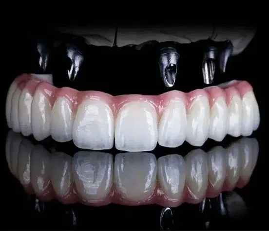 بهترین ایمپلنت های روزانه 1404| مقایسه کامل 2025