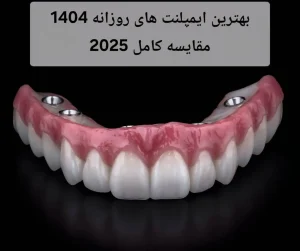بهترین ایمپلنت های روزانه 1404| مقایسه کامل 2025