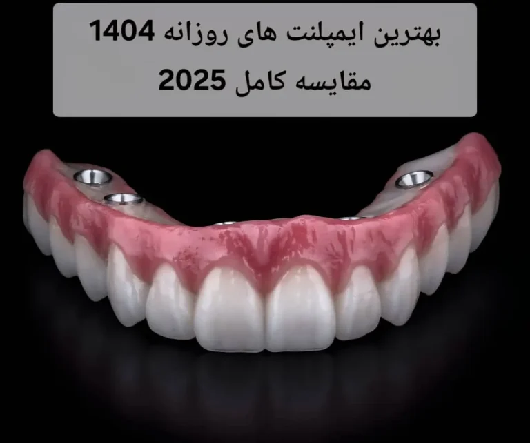 بهترین ایمپلنت های روزانه 1404| مقایسه کامل 2025