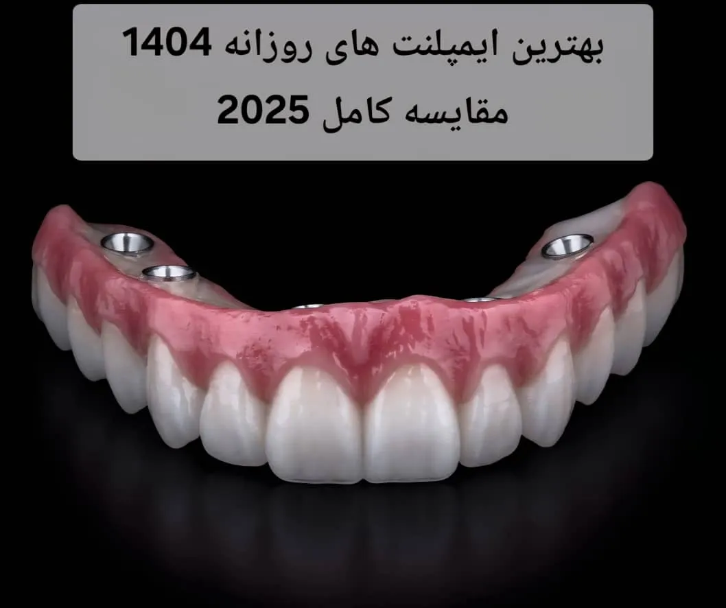 بهترین ایمپلنت های روزانه 1404| مقایسه کامل 2025