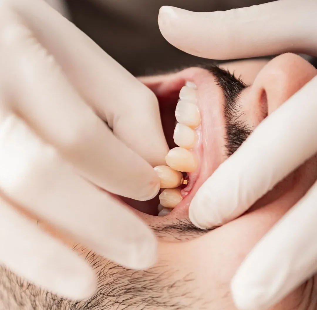 مشکلات رایج بعد از ایمپلنت دندان + پیشگیری 2025