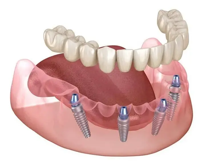 تفاوت پروتز ثابت و متحرک | راهنمای جامع و تخصصی 2025