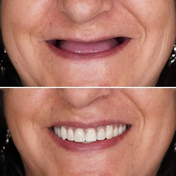 تفاوت پروتز ثابت و متحرک | راهنمای جامع و تخصصی 2025