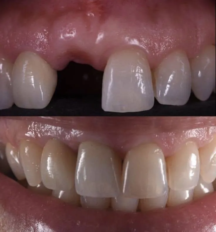 سوالات رایج بیماران قبل از ایمپلنت | راهنمای کامل و جامع 2025