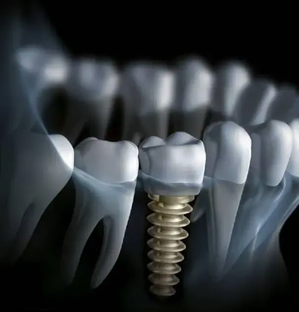 5 مزیت اصلی ایمپلنت فوری دندان که باید بدانید.