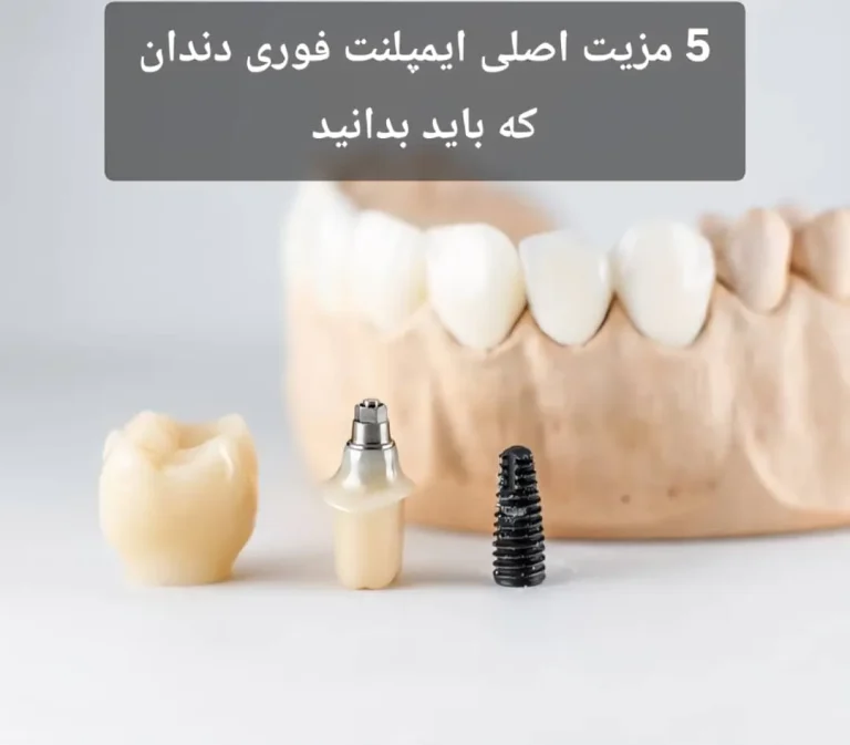 5 مزیت اصلی ایمپلنت فوری دندان که باید بدانید.