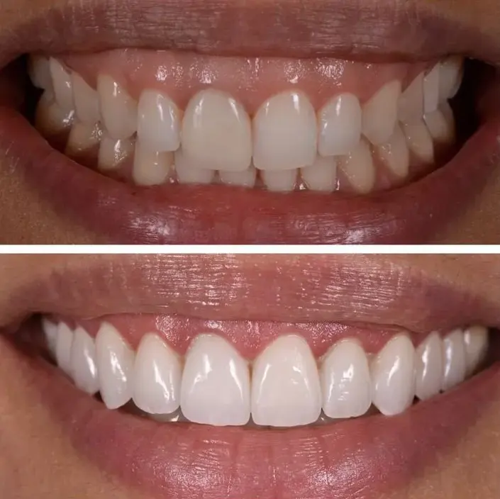 درمان‌های زیبایی دندان 2026: لمینت، کامپوزیت و بلیچینگ