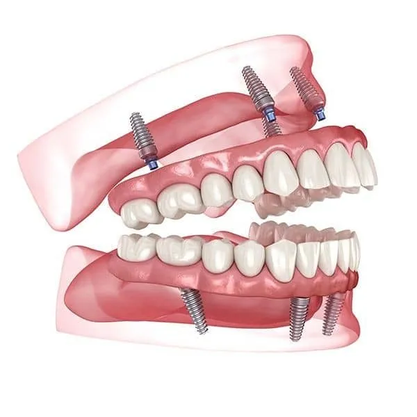 راهنمای جامع مراقبت از پروتز پس از 6 ماه