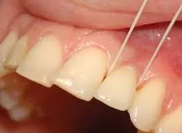 آموزش گام به گام نخ دندان کشیدن در روکش‌های ایمپلنتی