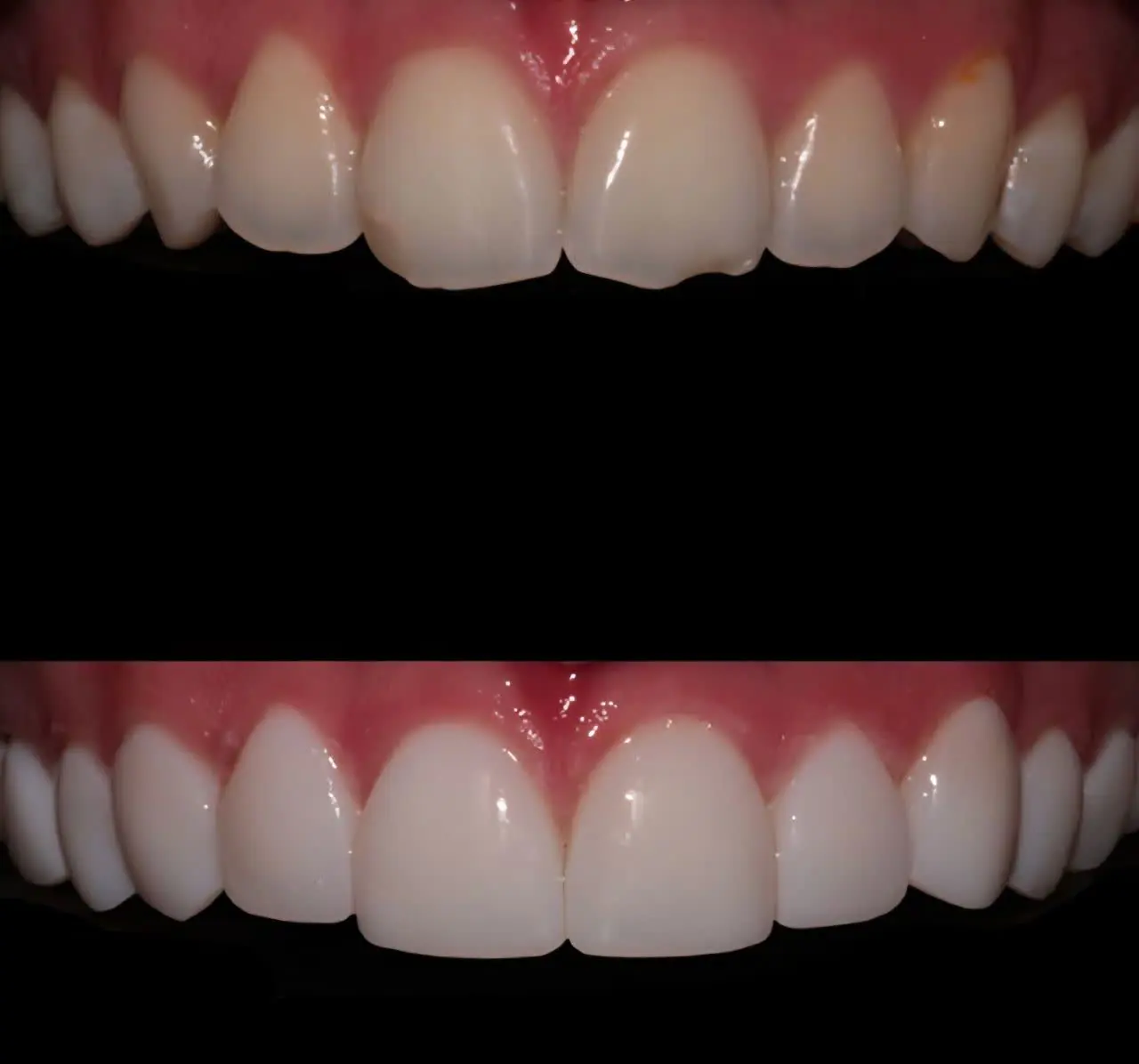 ونیر یا کامپوزیت؟ انتخاب بهترین روش برای لبخند شما