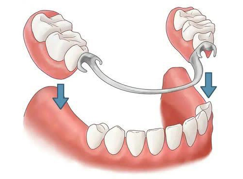 راهنمای جامع مراقبت از پروتز پس از 6 ماه