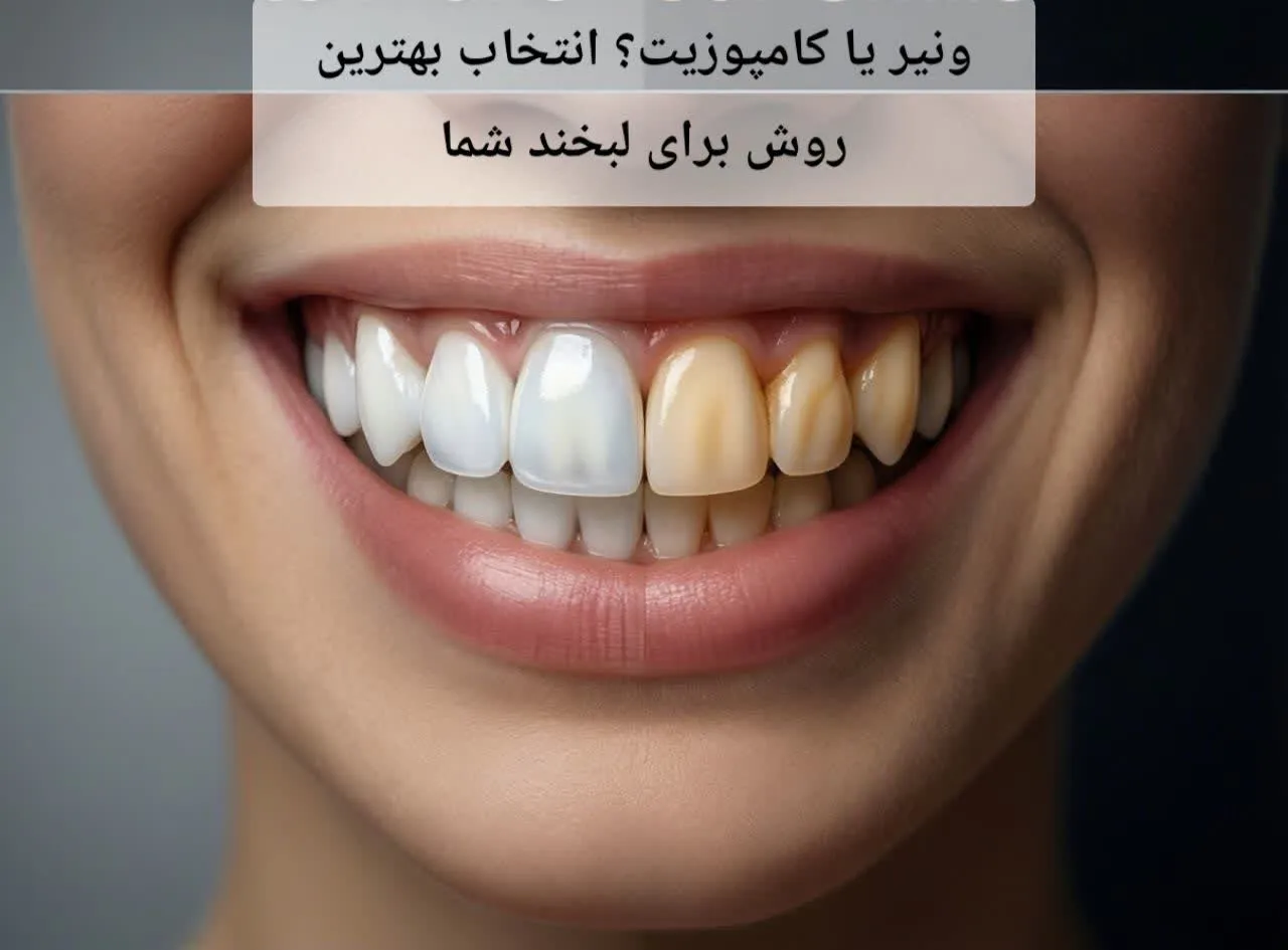 ونیر یا کامپوزیت؟ انتخاب بهترین روش برای لبخند شما