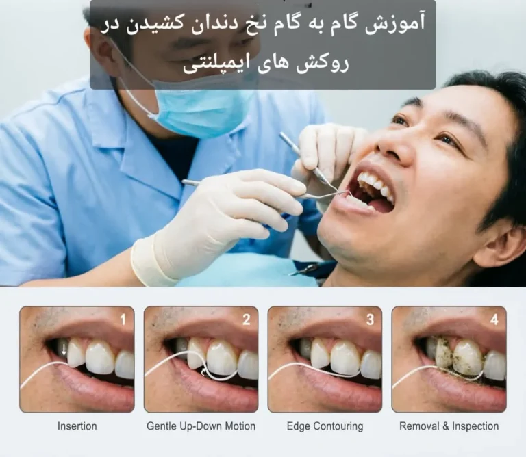 آموزش گام به گام نخ دندان کشیدن در روکشهای ایمپلنتی