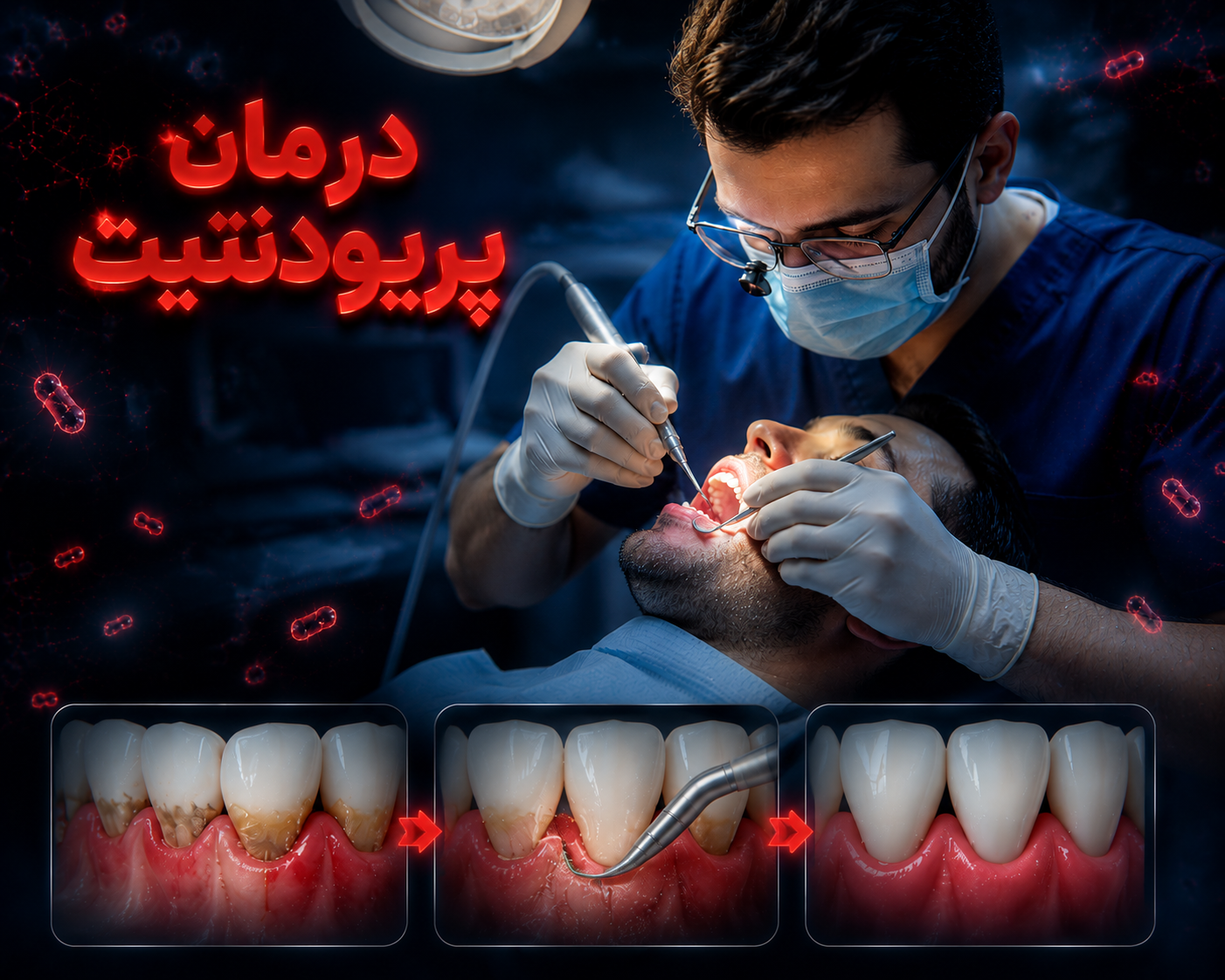 آیا جرمگیری برای درمان پریودنتیت کافی است؟