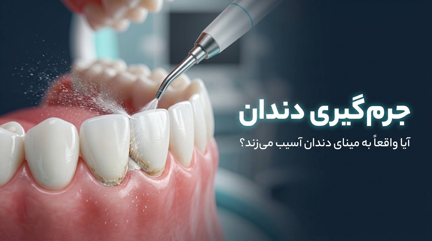 جرم گیری دندان