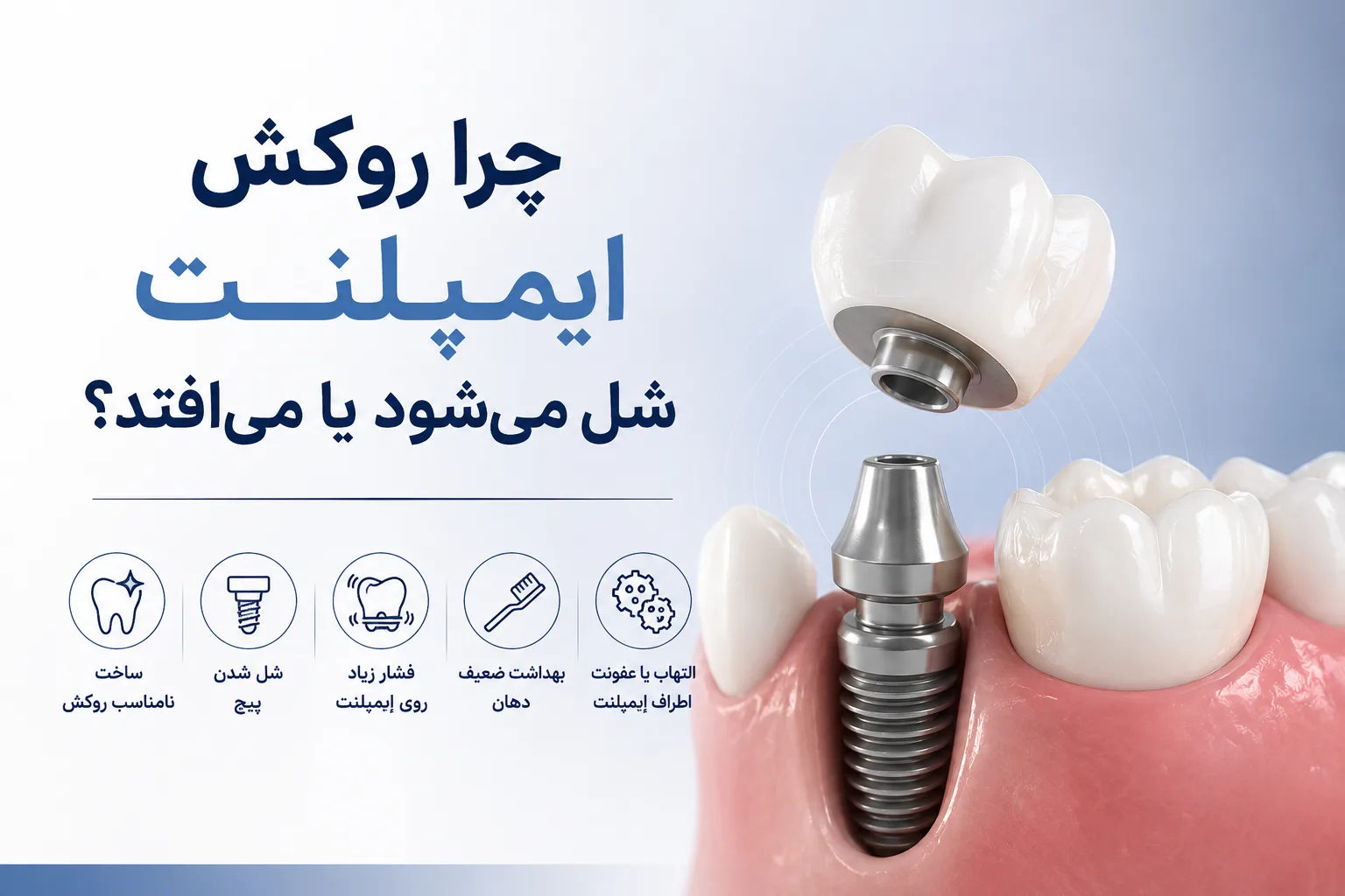 شل شدن روکش ایمپلنت