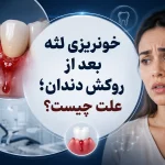 خونریزی لثه بعد از روکش دندان؛ علت چیست؟