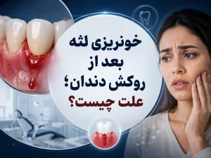 خونریزی لثه بعد از روکش دندان؛ علت چیست؟